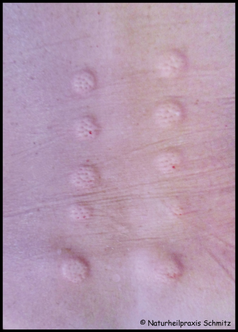 Segmenttherapie, Quaddelung, Quaddeln, intrakutane Injektion, Heilungsreiz, Behandlung innerer Organe von außen